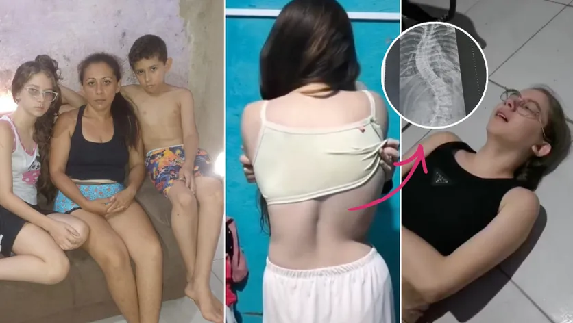 Ariela Mel, 14 anos, que precisa de cirurgia urgente na coluna após anos cuidando de familiares